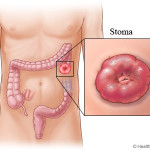 OneMed Colostomy Bag
