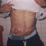 OneMed Colostomy Bag